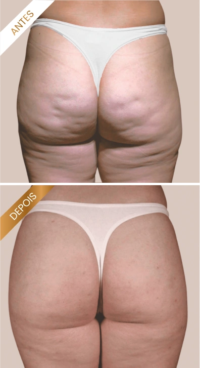 Antes e Depois GoldIncision 3